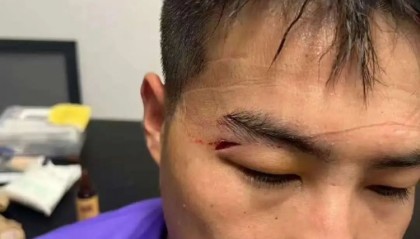 津媒：王献钧两颗门牙被撞断，杨帆眉骨受伤赛后去医院缝针